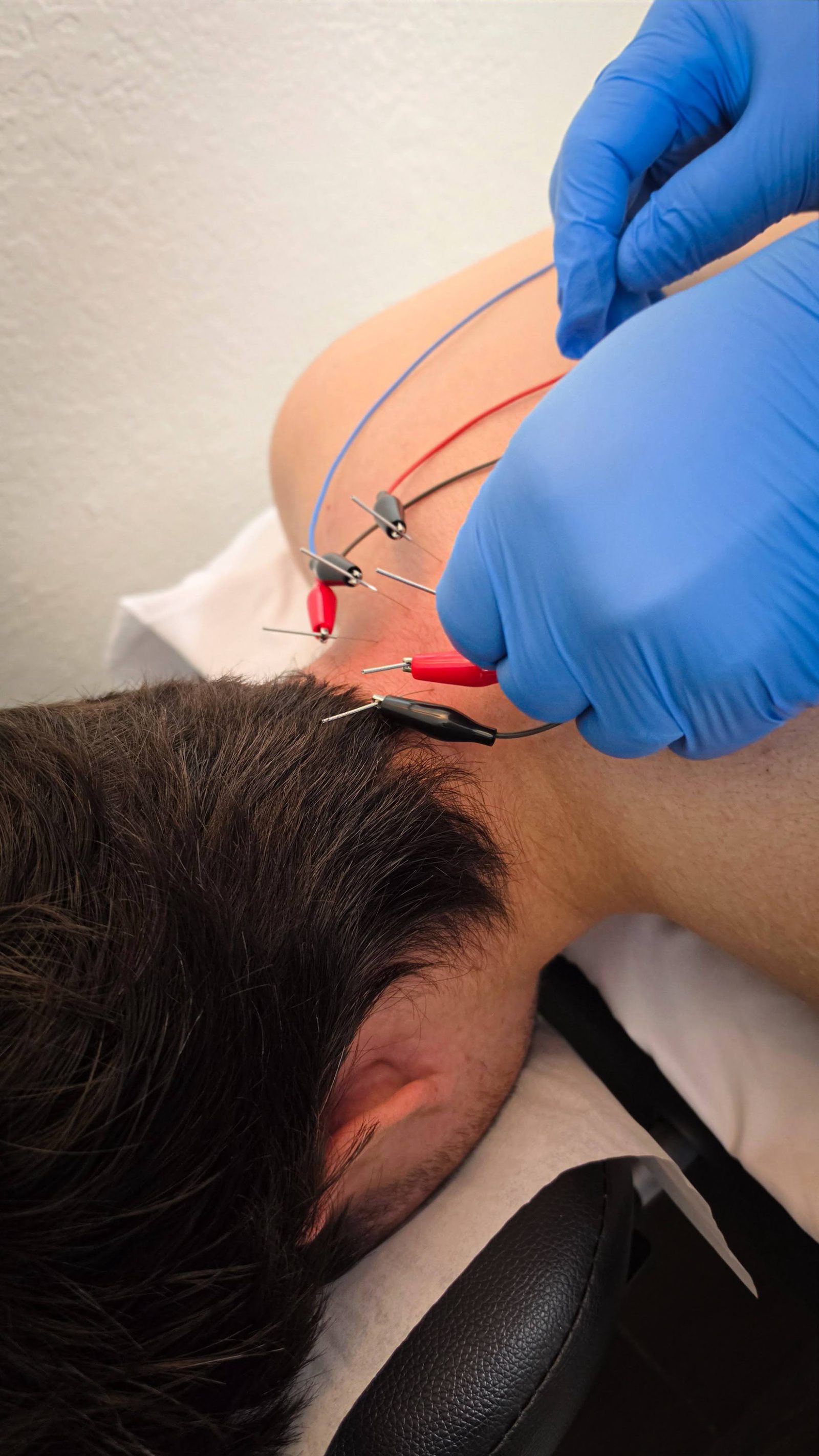Dry needling with electric stim at Copper State Chiropractic